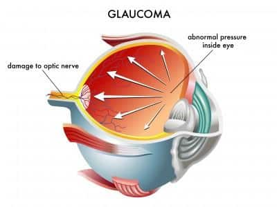 glaucoma