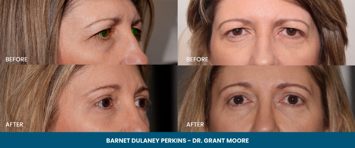 Before and after of eyelid surgery patient