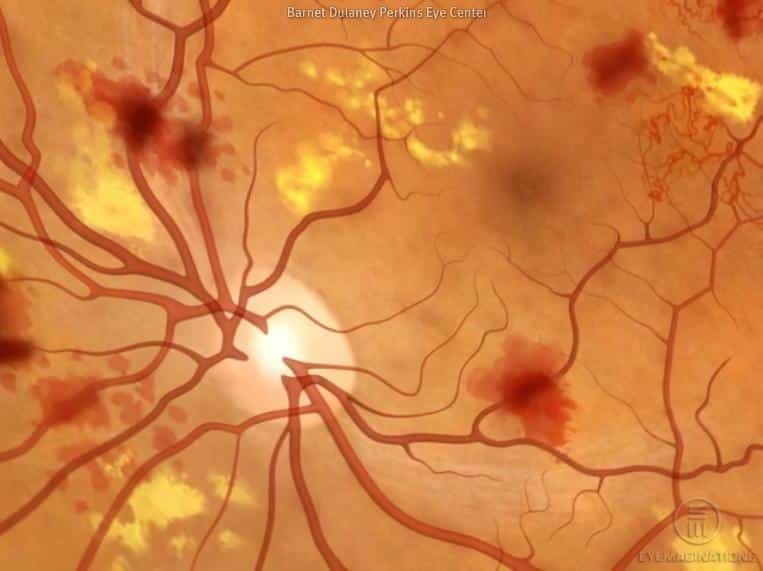 diabetic retinopathy retina
