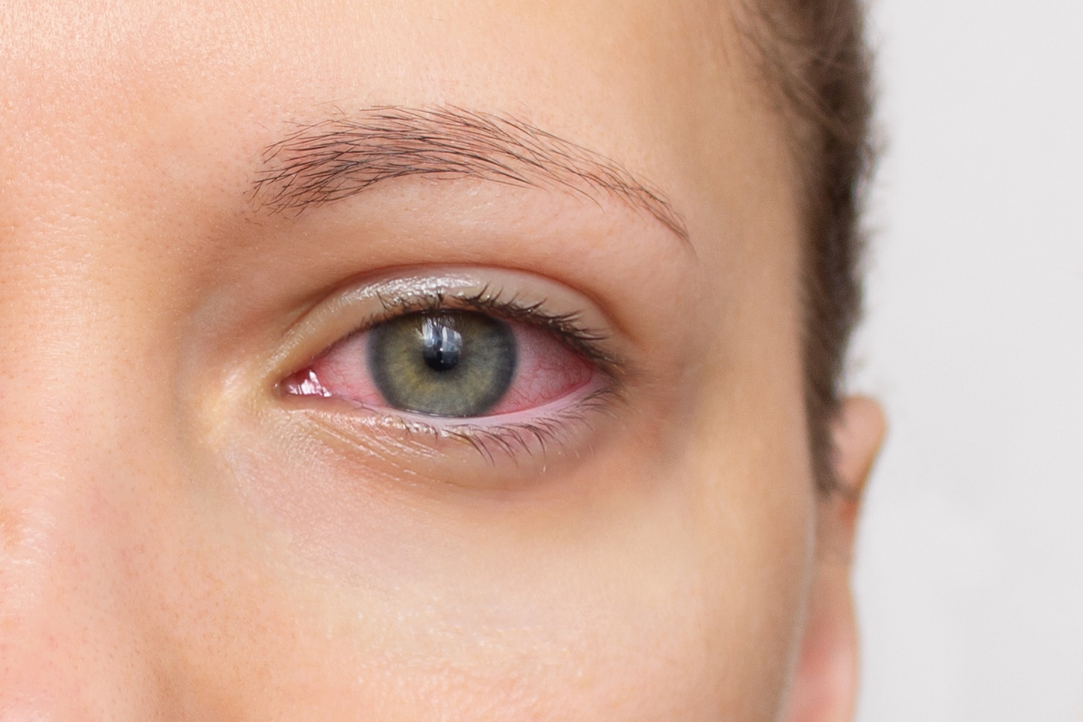 Close-up of a person’s eye showing redness and irritation along the lower eyelid.