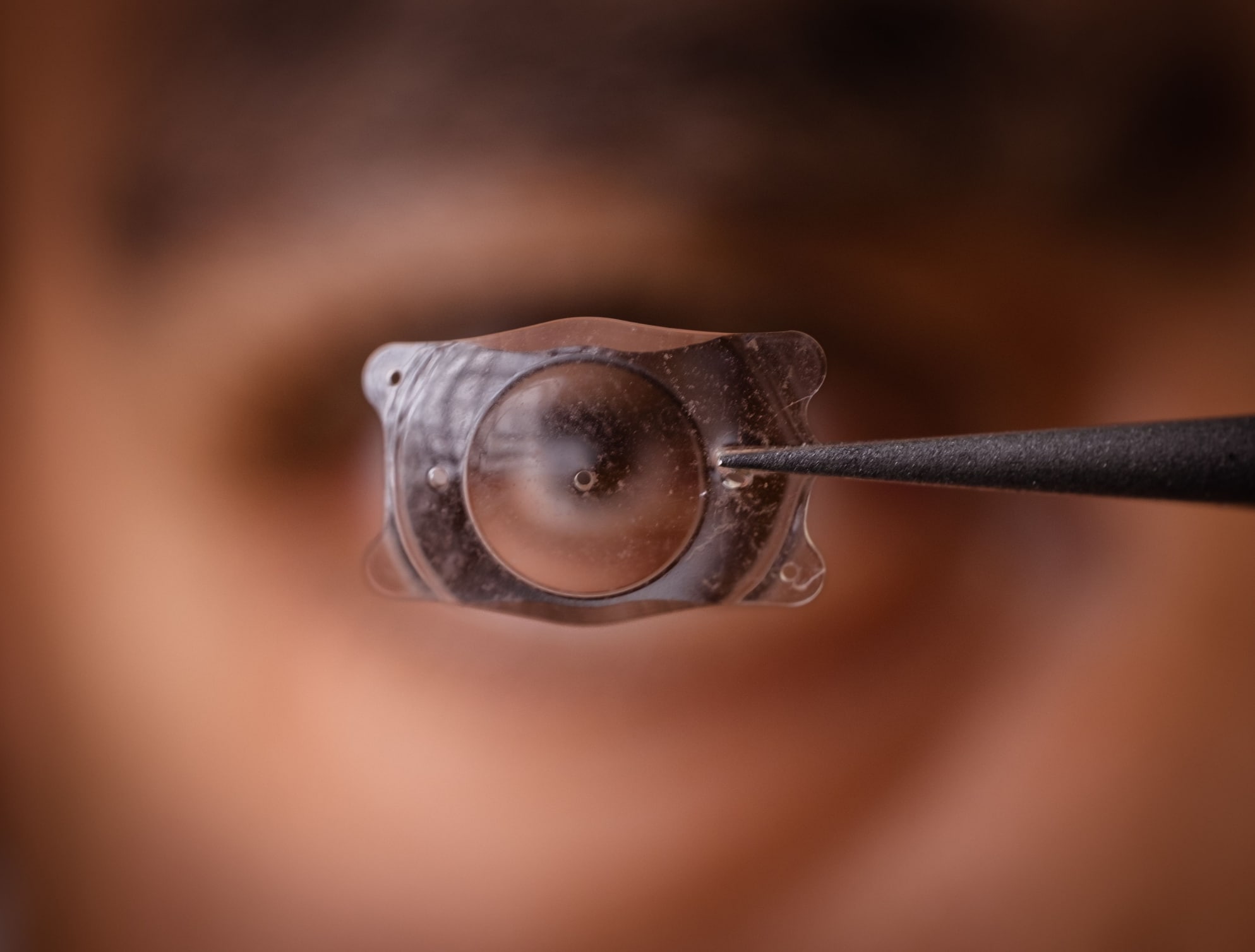Close-up of forceps holding a folded intraocular lens implant in front of a blurred patient’s eye.
