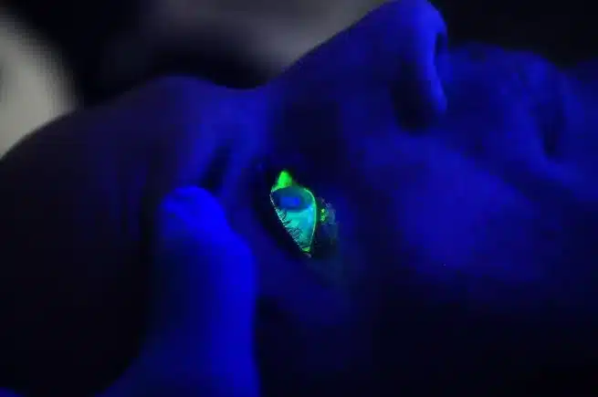A patient receiving fluorescein angiography
